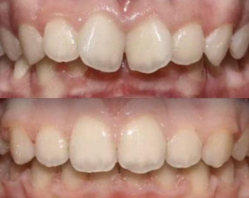 Брекети, елайнери, ортодонт Львів - <ro>Изображение</ro><ru>Изображение</ru> #1, <ru>Объявление</ru> #1738536