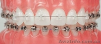 Стоматолог - ортодонт. Постановка брекетов. - <ro>Изображение</ro><ru>Изображение</ru> #4, <ru>Объявление</ru> #1253356