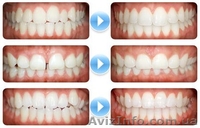 Стоматолог - ортодонт. Постановка брекетов. - <ro>Изображение</ro><ru>Изображение</ru> #3, <ru>Объявление</ru> #1253356