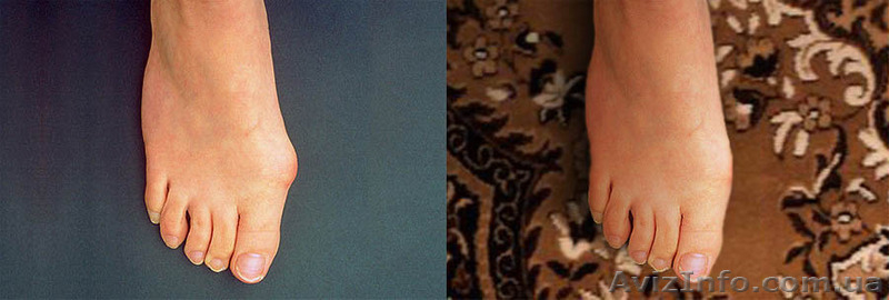 Фиксатор для косточки на ноге Valgus Plus c 50% скидкой!       - <ro>Изображение</ro><ru>Изображение</ru> #4, <ru>Объявление</ru> #1141452