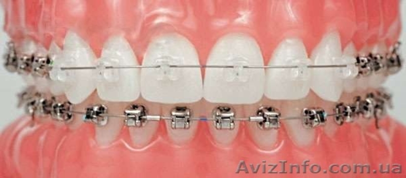 Стоматолог - ортодонт. Постановка брекетов. - <ro>Изображение</ro><ru>Изображение</ru> #4, <ru>Объявление</ru> #1253356